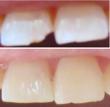Clínica Dental Buccaris, Zahnarztpraxis, Madrid, Spanien, Schneidezahn vorher und nachher