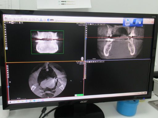 Clínica Odontológica de Postgrados Universitarios, Zahnarztpraxis, Madrid, Spanien, Kontrolle nach ziehen des alten Implantates