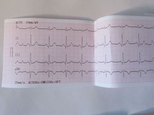 Clinica Virgen del Camino, Madrid, Spanien, Ergebnis EKG ohne Belastung
